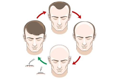 <strong><strong>Hair Transplant In Delhi NCR</strong></strong>